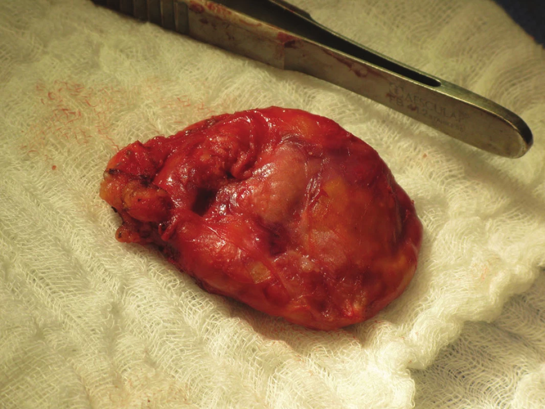 Preparát příštítného adenomu
Fig. 4: Preparation of the parathyroid tumour