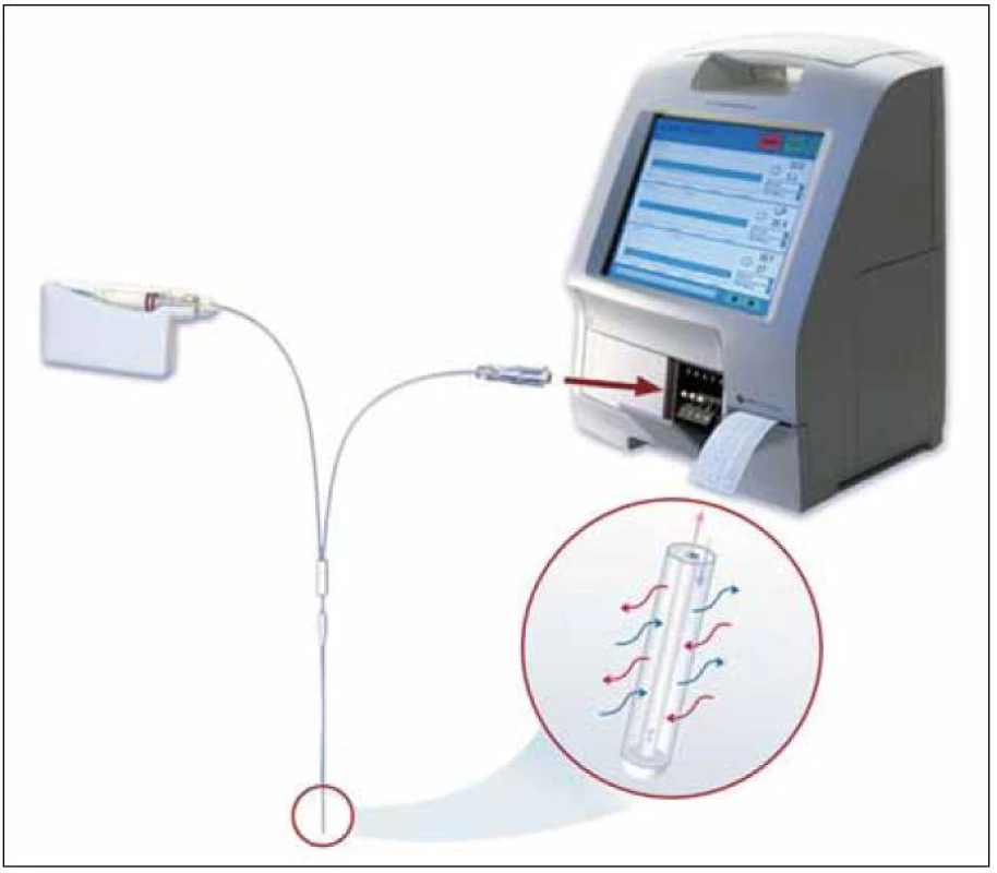 Schéma diskontinuálního systému, zleva: klinická pumpa, trubice, sonda, mikrozkumavka, transmembránová difuze, POCT analyzátor s dotekovým displejem a tiskárnou (zdroj: www.microdialysis.se).