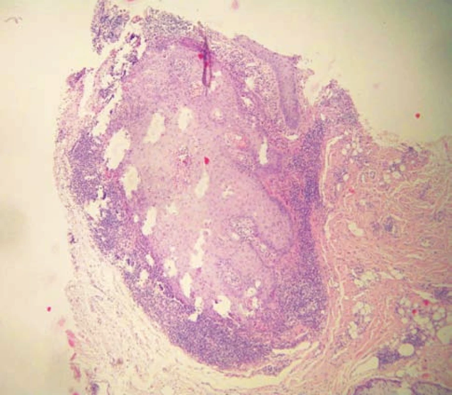 Histologický nález
Vlasový folikul v šikmém řezu má akantotickou stěnu, ke které přiléhá pruhovitý infiltrát lymfocytů (HE, 40x)