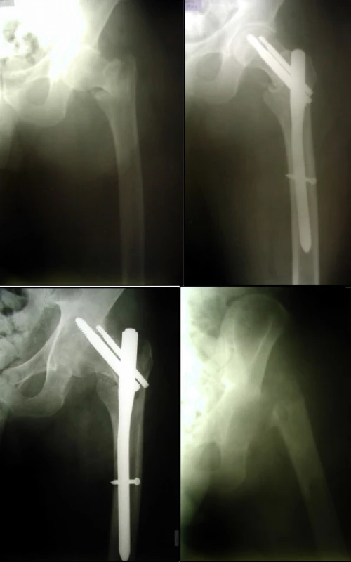 muž, 56 let se stabilní pertrochanterickou zlomeninou (a), stabilizace krátkým PFN b), na rtg snímku po 12 týdnech proximální proříznutí při osteomyelitidě (c), stav vyřešen až extirpací hlavice (d)