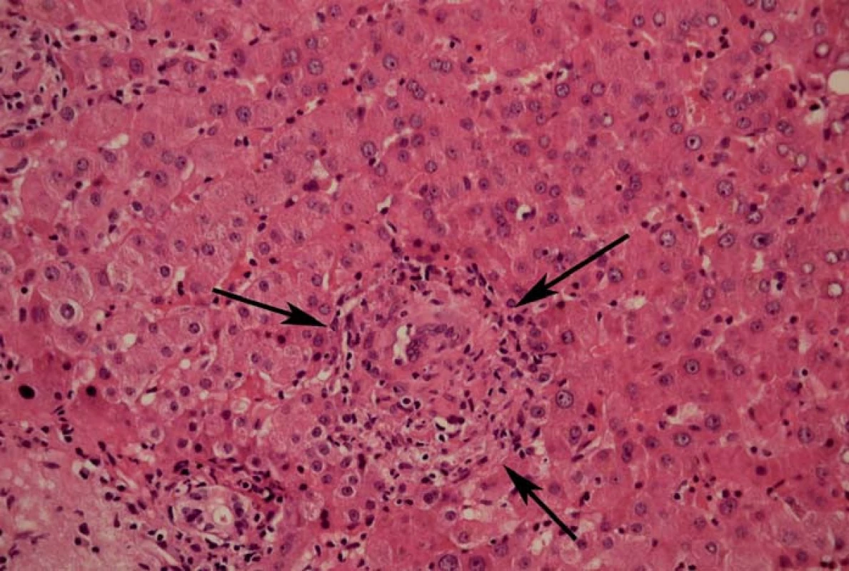 Detail jednoho z četných nekazeifikujících epiteloidních granulomů infiltrovaných lymfocyty (šipky), některé i s obrovskými buňkami Langhansova typu.
Fig. 2. Detail of one of numerous non-caseating epithelioid granulomas with lymphocyte infiltration (marked with arrows), some of them with Langhans giant cells.