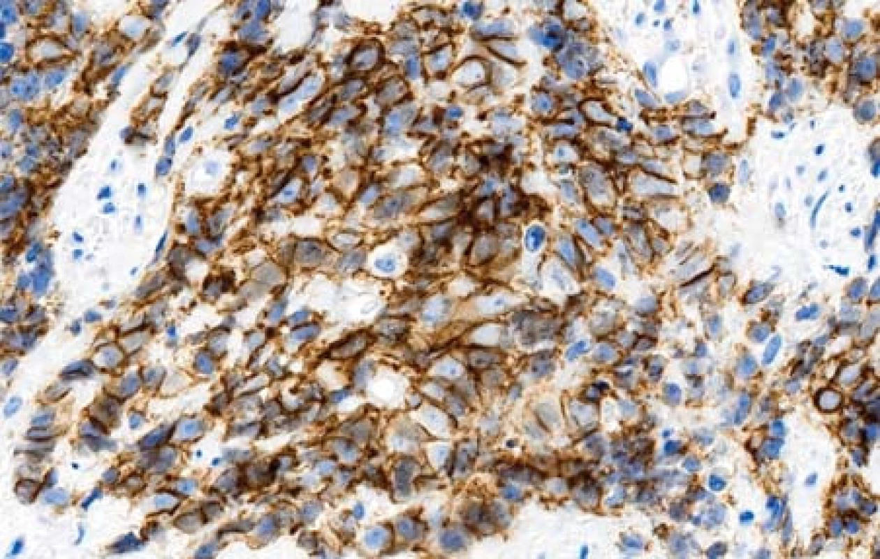 Membránová pozitivita nádorových buněk s protilátkou proti CD 56 (imunohistologie, 400x).