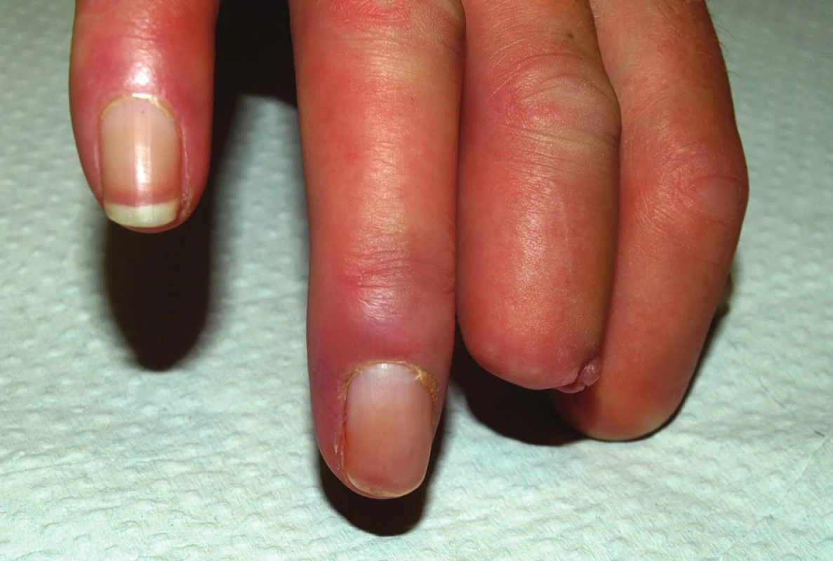 Stav v srpnu 2010.
Zhojení defektu na dorzální straně distálního článku 4. prstu pravé ruky.