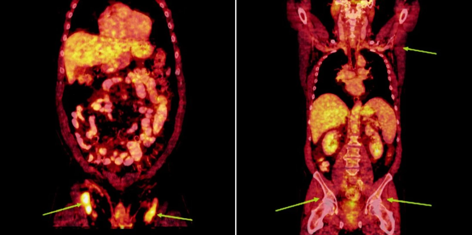 Srovnání snímků integrované pozitronové emisní tomografie (s použitím 18F-fluoro-deoxy-glukózy) a počítačové tomografie při relapsu (a) a po skončení léčby 90Y-ibritumomab tiuxetanem (b) u třetího pacienta s folikulárním lymfomem.