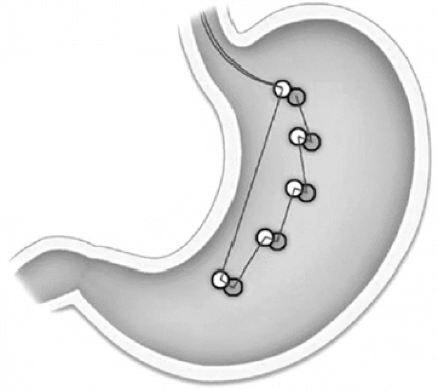 Schéma endoluminální plikace žaludku