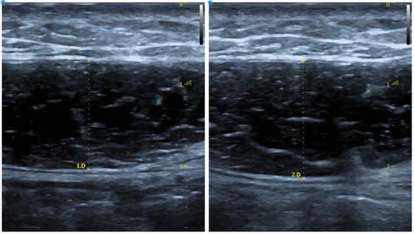 a. Ultrazvukové snímky s vyznačenými lineárními rozměry pro levý (1.D) a pravý (2.D) přímý břišní sval.