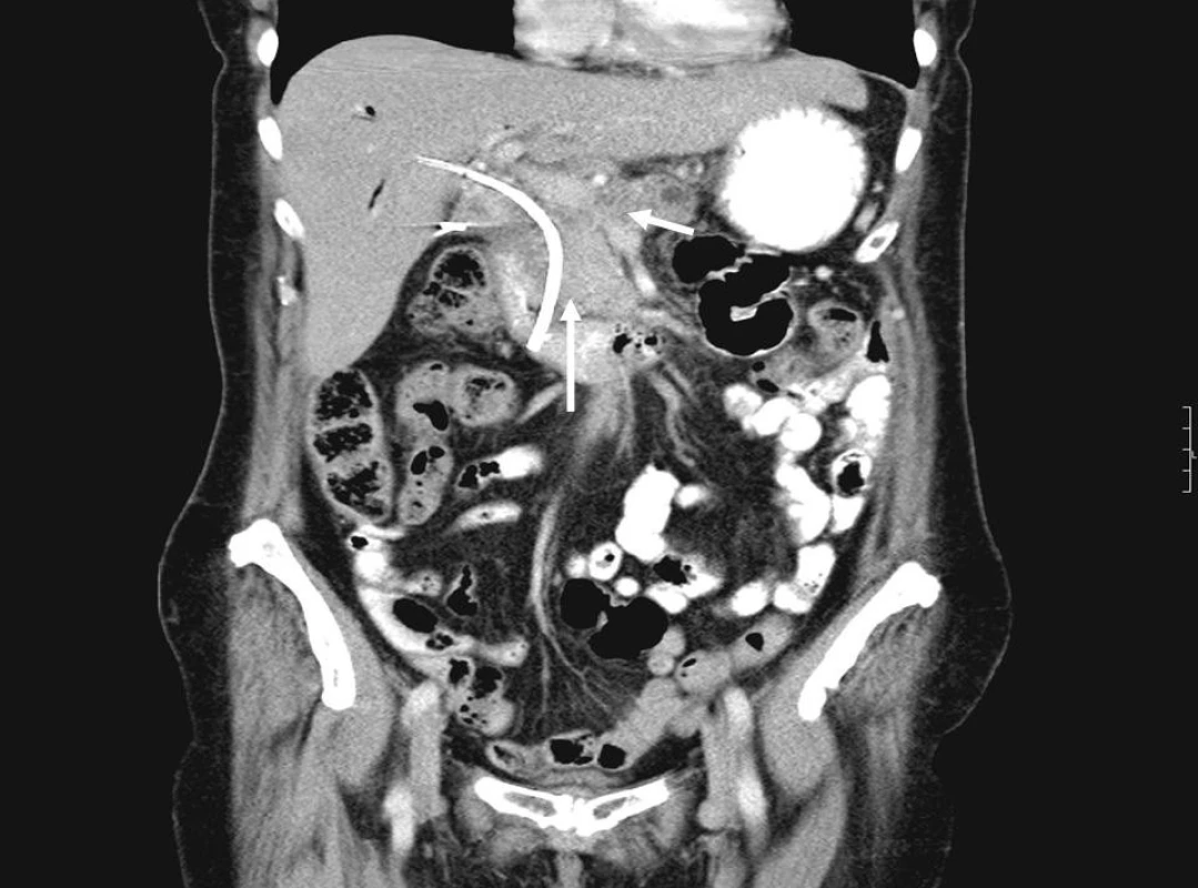CT obraz karcinomu pankreatu se zavedeným biliárním stentem