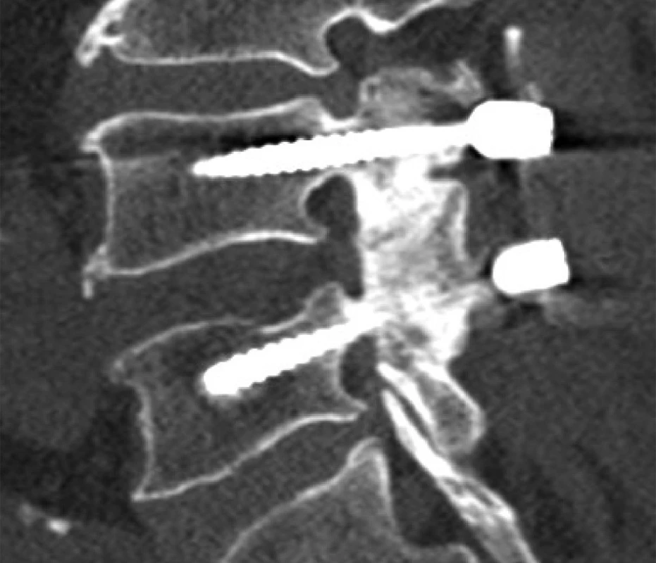 CT LS páteře stejného pacienta Sagitální rekonstrukce v kostním okně na úrovni pravého meziobratlového kloubu. Nitrokloubní artrodéza se šrouby zavedenými transpedikulárně a zachováním dostatečně silných kostních můstků na processus articulares L4 a L5.
Fig 4: CT scan of the same patient Sagital reconstruction in the bone window at the level of the right intervertebral joint. Intrarticular arthrodesis with TP screws and with preservation of the bone bridges of articular processes L4 and L5 vertebrae.
