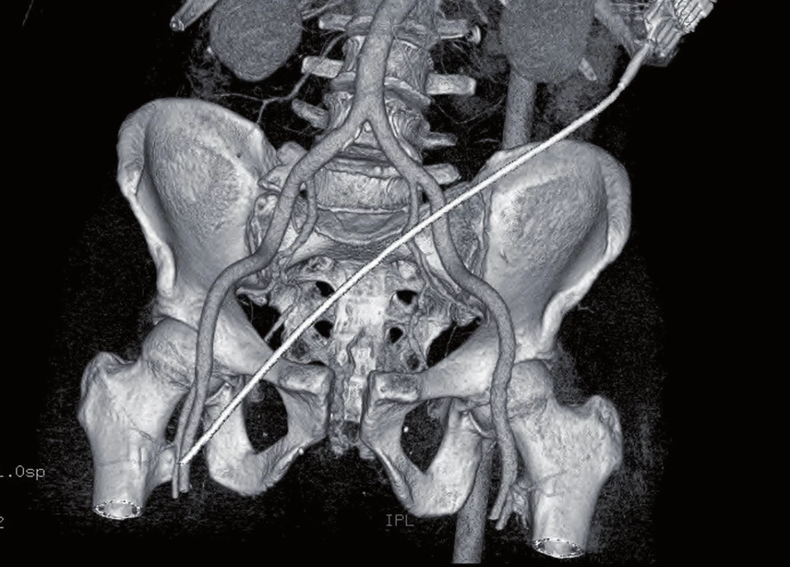 3D CT rekonstrukce poranění pánve - AO 61 B.11