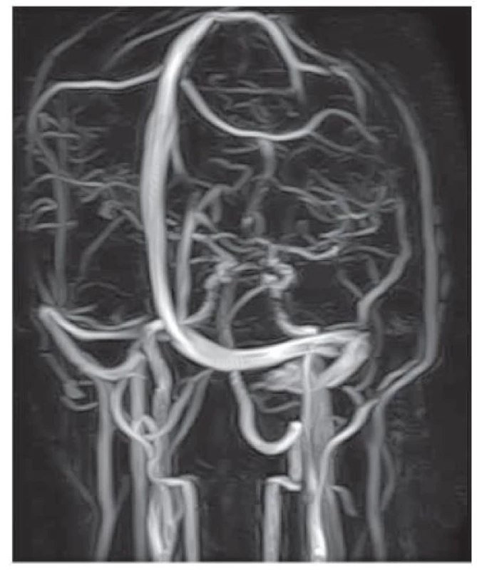 MRI venogram – hypoplazie sinus transversus a sinus sigmoideus vpravo