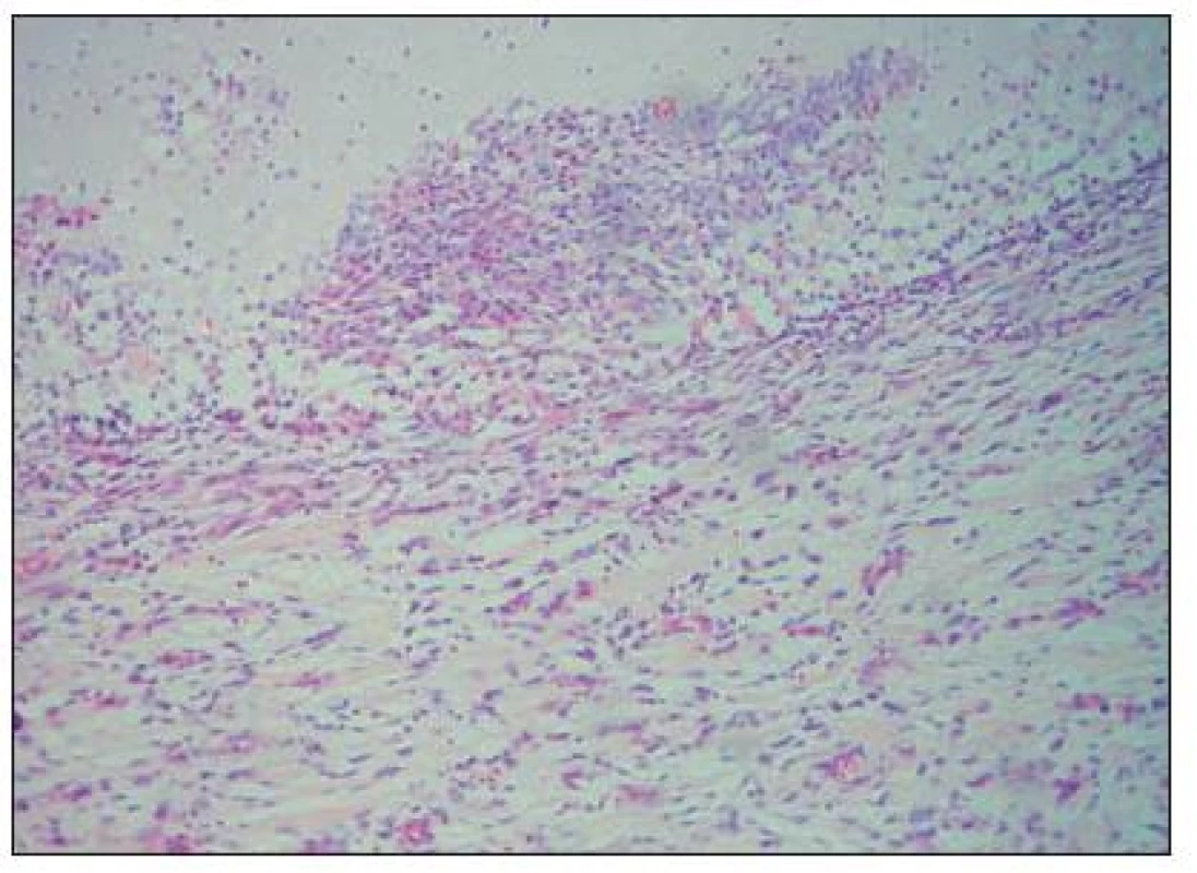 Méně buněčný úsek s myxoidním prosáknutím intersticia tvořeného silnými snopci kolagenního vaziva infiltrovaného leukocyty, v horní části je patrna pseudocystická dutina vyplněná mukoidní substancí (barveno hematoxylin-eozinem, originální zvětšení 100×)