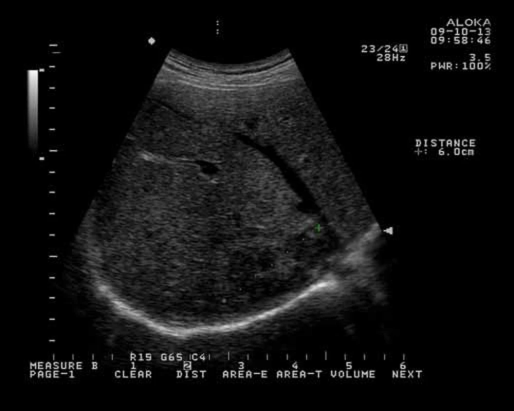 Ultrasonografický nález heteroechogenního ložiska v ústí jaterních žil do vena cava.
Fig. 1. Ultrasound finding of heteroechoic mass in confluens of liver veins in vena cava.