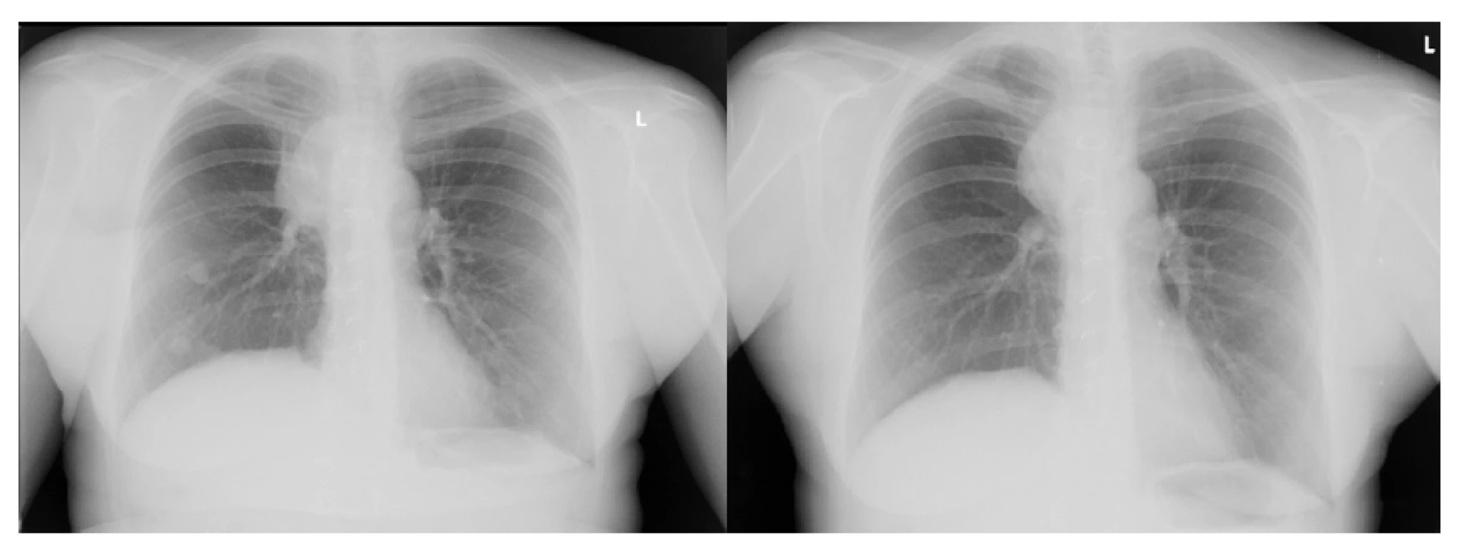 Skiagram hrudníku před zahájením léčby nivolumabem
a po dvou měsících léčby – regrese plicních metastáz vpravo
a zmenšení nádorové masy vpravo paratracheálně