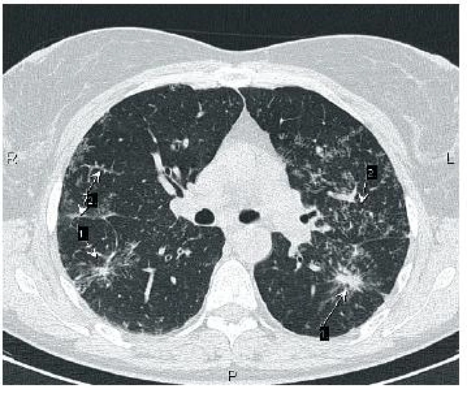 Fibróza plic s bronchiektáziemi č. 2 a přetrvávající uzlíky č. 1 svědčící pro aktivitu onemocnění
