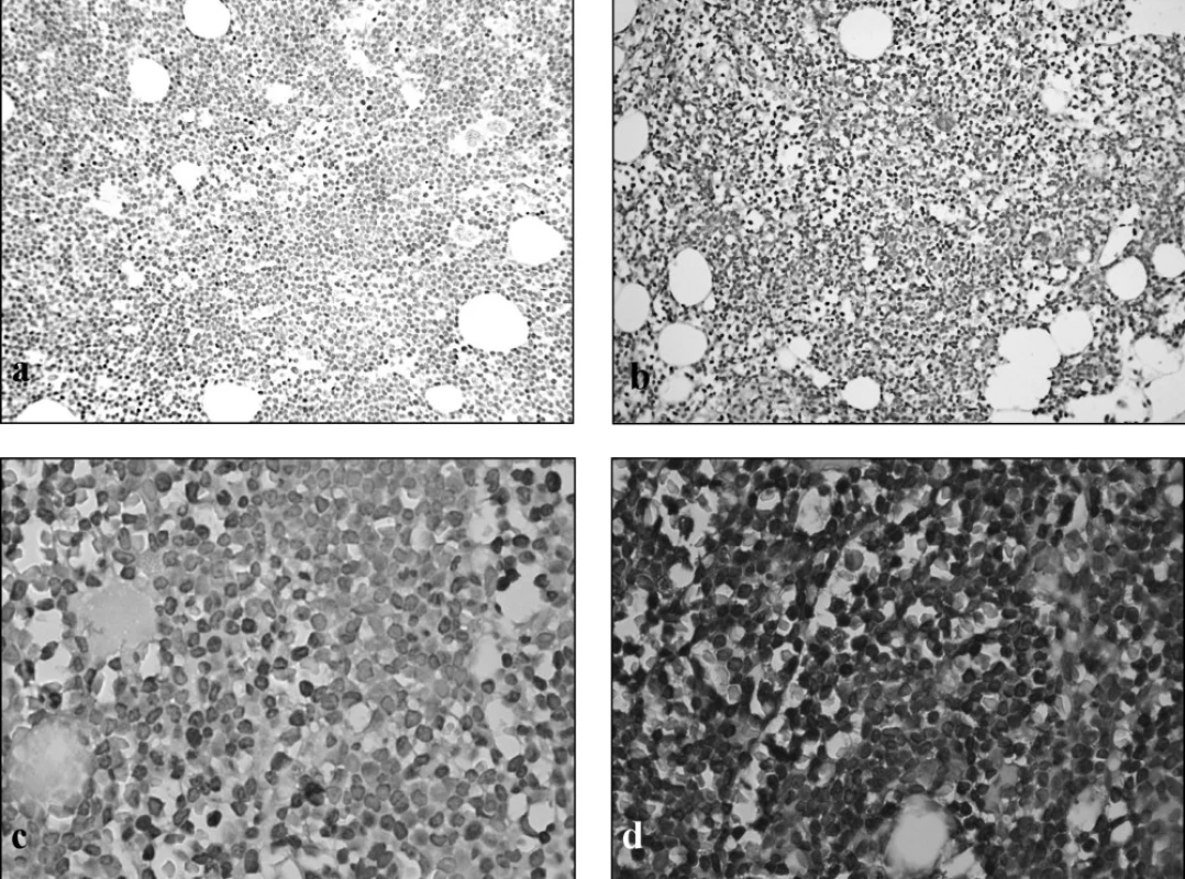 Histologický obraz jadrovej pozitivity markera ZAP-70 vo vzorkách s B-CLL. Jednoznačne negatívny nález - menej ako 5 % buniek pozitívnych (a), jednoznačne pozitívny nález - viac ako 30 % buniek s pozitívnymi jadrami (b). V prípadoch nepravidelnej pozitivity pri štandardnom imunohistochemickom farbení (c) bolo možné zatriediť prípady po použití amplifikačnej metódy spracovania – pozitívny nález (d). Avidin-biotin-peroxidázový komplex, diaminobenzidin, a, b: 200-krát, c, d: 400-krát
