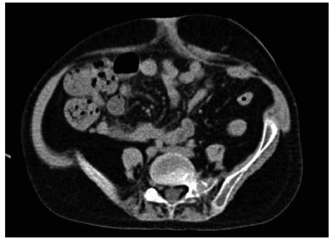 CT vyšetrenie brucha pacientky s Crohnovou chorobou s nálezom fistúl a abscesov 
v periumbilikálnej oblasti.
Fig. 2. Abdominal CT scan of Crohn‘s disease patient with periumbilical abscesses and fistulas.