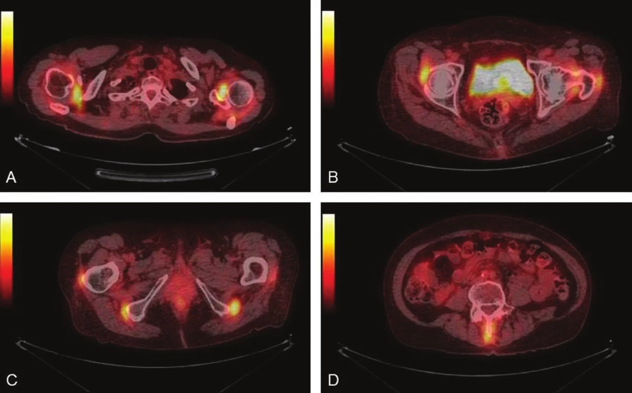 Hypermetabolismus &lt;sup&gt;18&lt;/sup&gt;F-FDG v oblasti ramenních (A) a kyčelních (B) kloubů, 
v ichschiogluteálních (C) a interspinózních burzách (D). PET/ CT fúzované transverzální řezy.