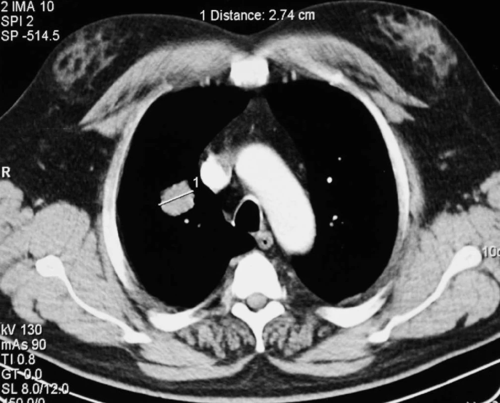 Předoperační CT plic – ložisko v S2 pravé plíce
Fig. 1: Preoperative lung CT scan – a focus in the right lung S2