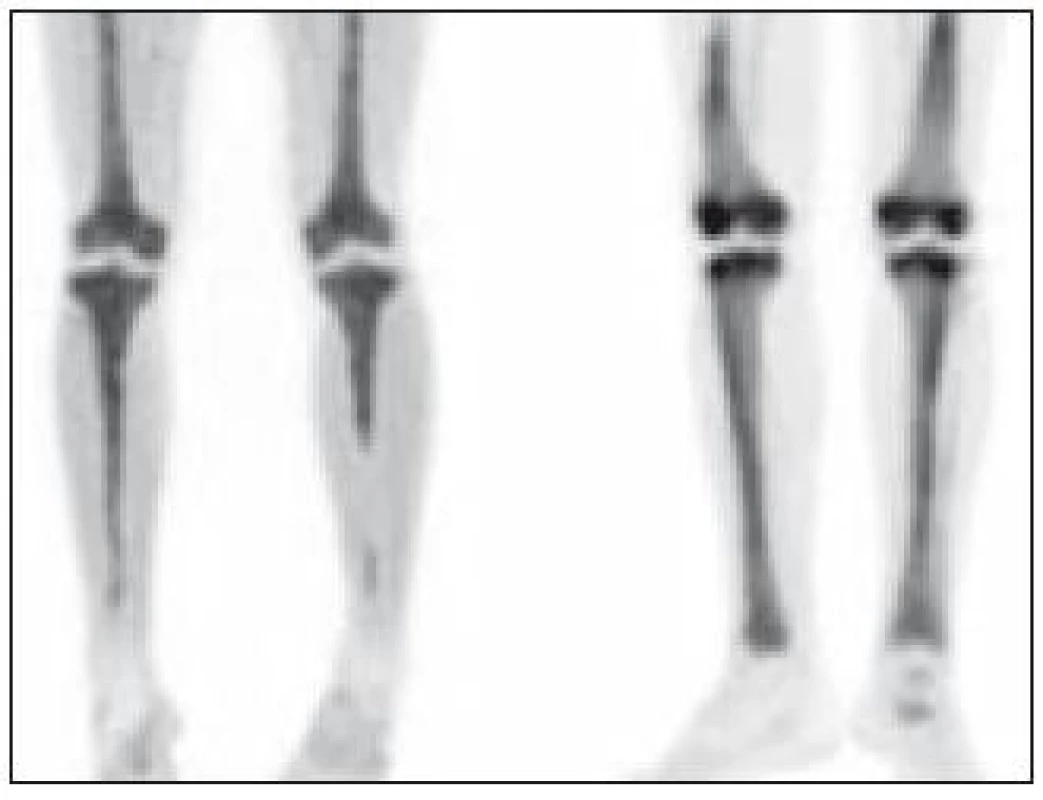 MIP (Maximum Intensity Projections) PET dolních končetin u 2 pacientů s Erdheimovou-Chesterovou chorobou, kterými lze získat trojrozměrnou představu o distribuci radiofarmaka fluorodeoxyglukózy (FDG).

Ložiska zvýšené akumulace radiofarmaka nacházíme u obou pacientů bilaterálně ve stehenních a bércových kostech s maximem postižení v oblasti distálních femorů a proximálních tibií.