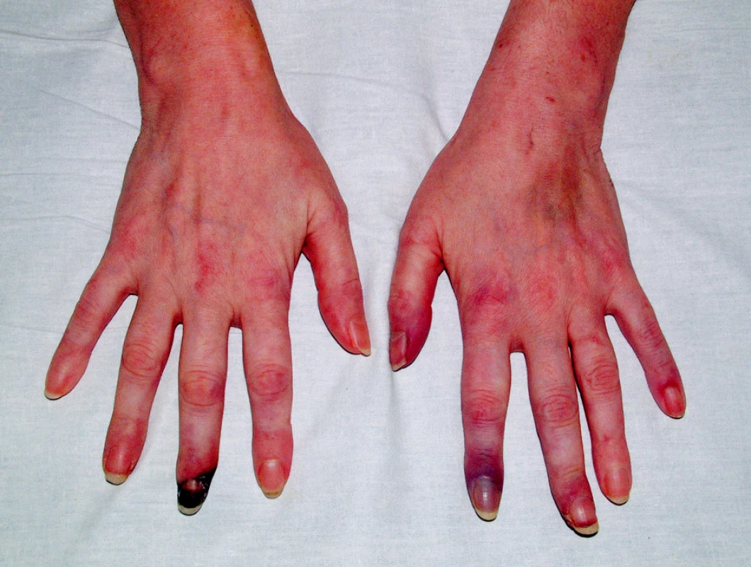 Gangrény prstů v důsledku vaskulitidy.