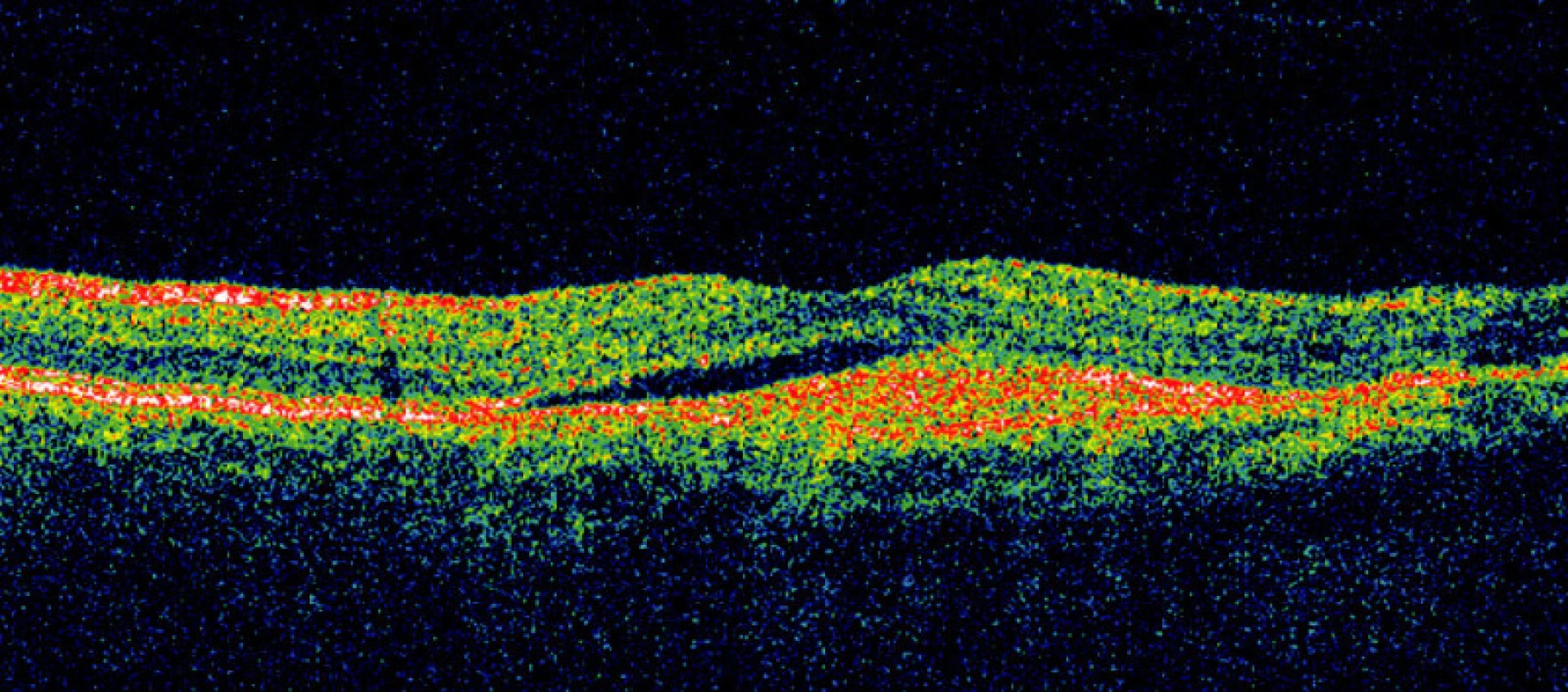 OCT scan (180 st.) pravého oka pacienta před FTV/RIV