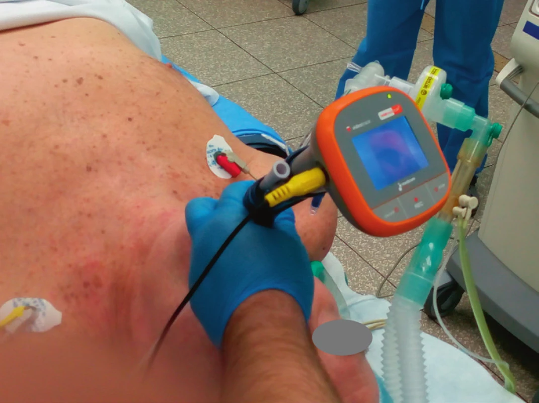 Zavedení pomůcky a zobrazení vchodu do hrtanu u pacienta s předpokládanou antepozicí hlasových vazů