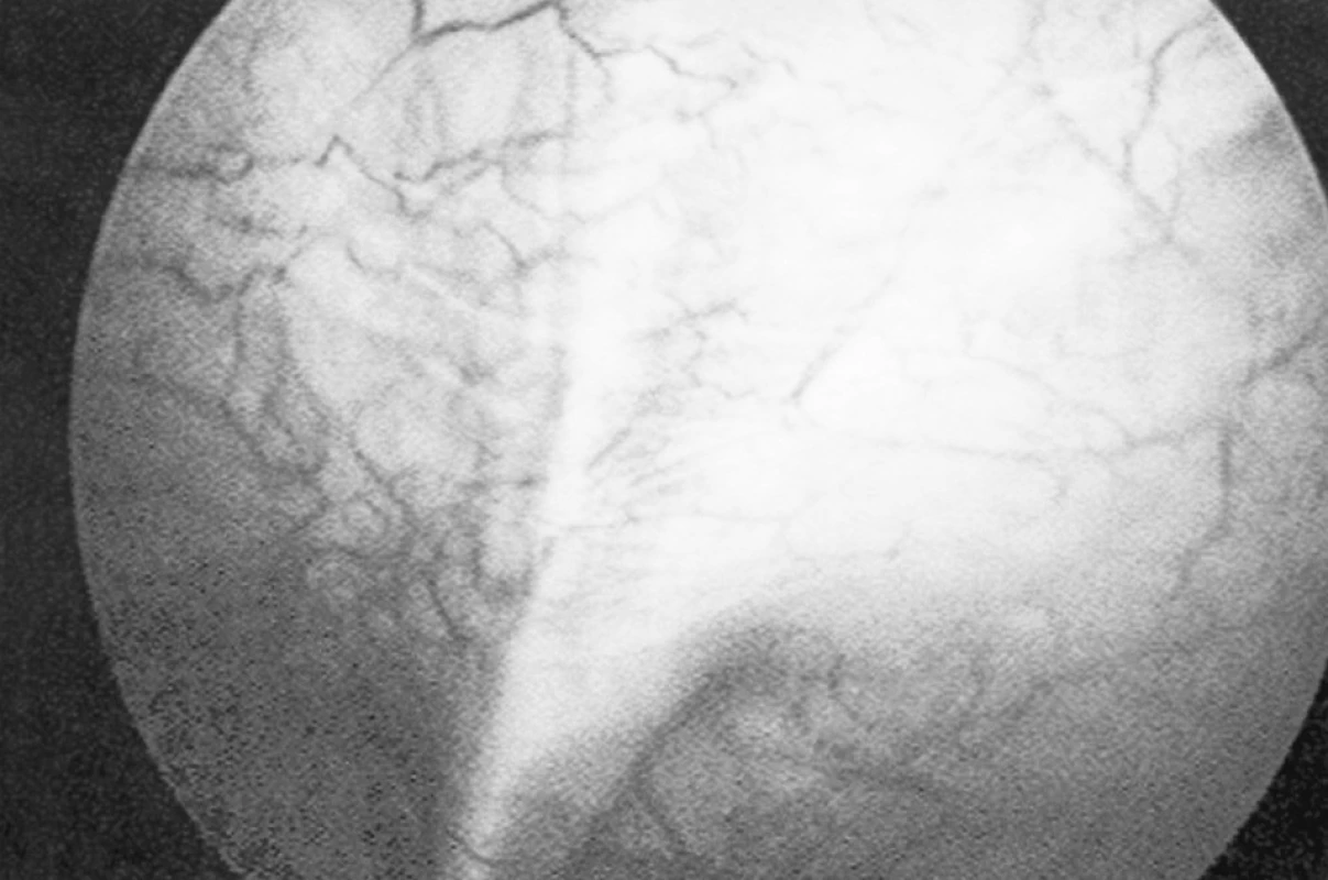 Větvení dilatované umbilikální žíly nad pupkem
Fig. 2. Separating of the dilatated umbilical vein above the umbilicus