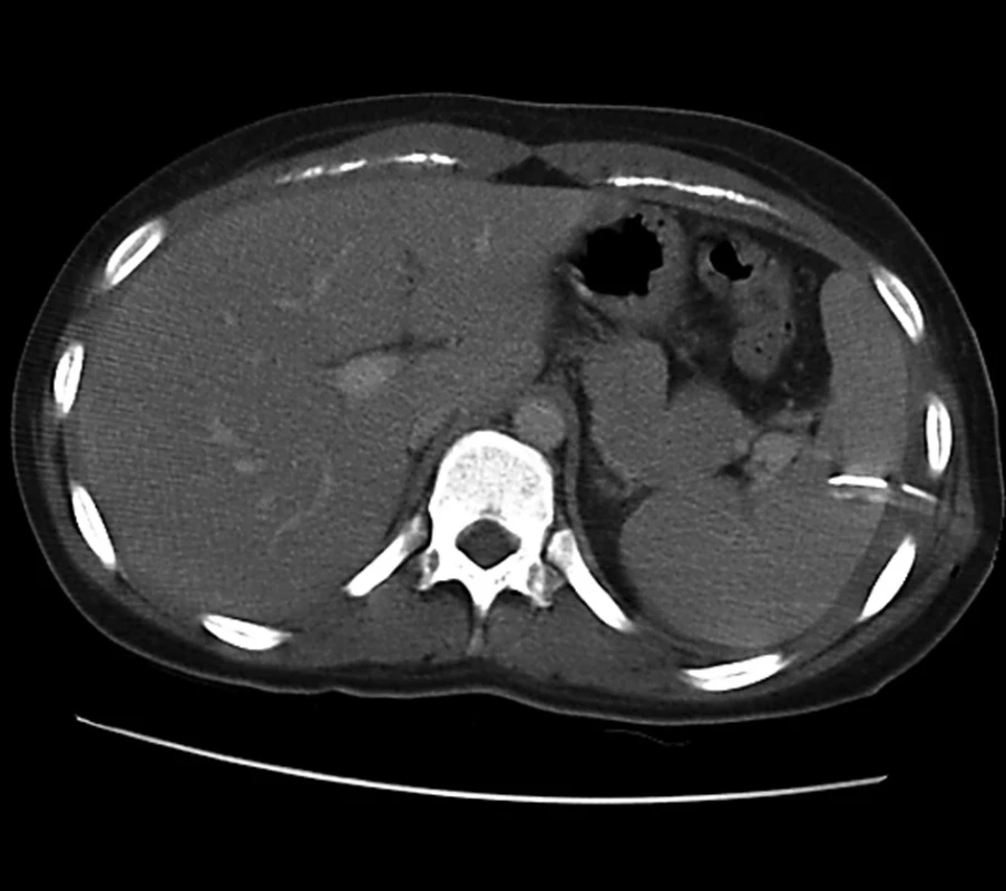 Chybné zavedení hrudního drénu do sleziny
Fig. 5: Misplacement of the chest drain into the spleen
