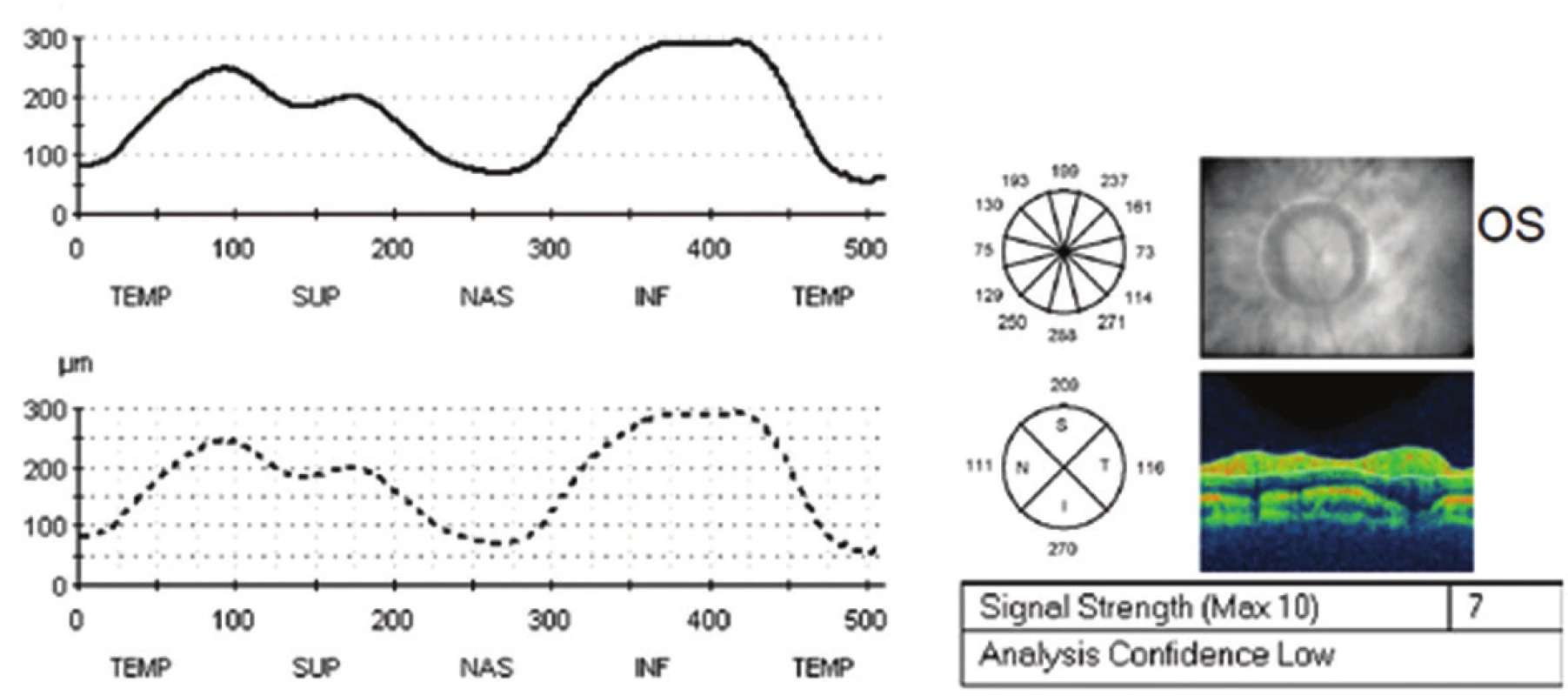 Vstupní měření vrstvy nervových vláken sítnice k monitoraci edému papily zrakového nervu původně na optické koherenšní tomografii Stratus Zeiss na levém oku