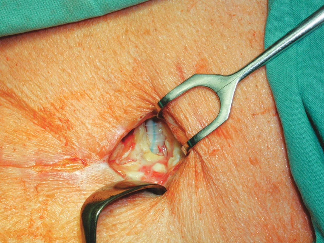 Stav po nekrektomii před přiložením V.A.C.
Fig. 2. A wound after necrectomy before V.A.C. application