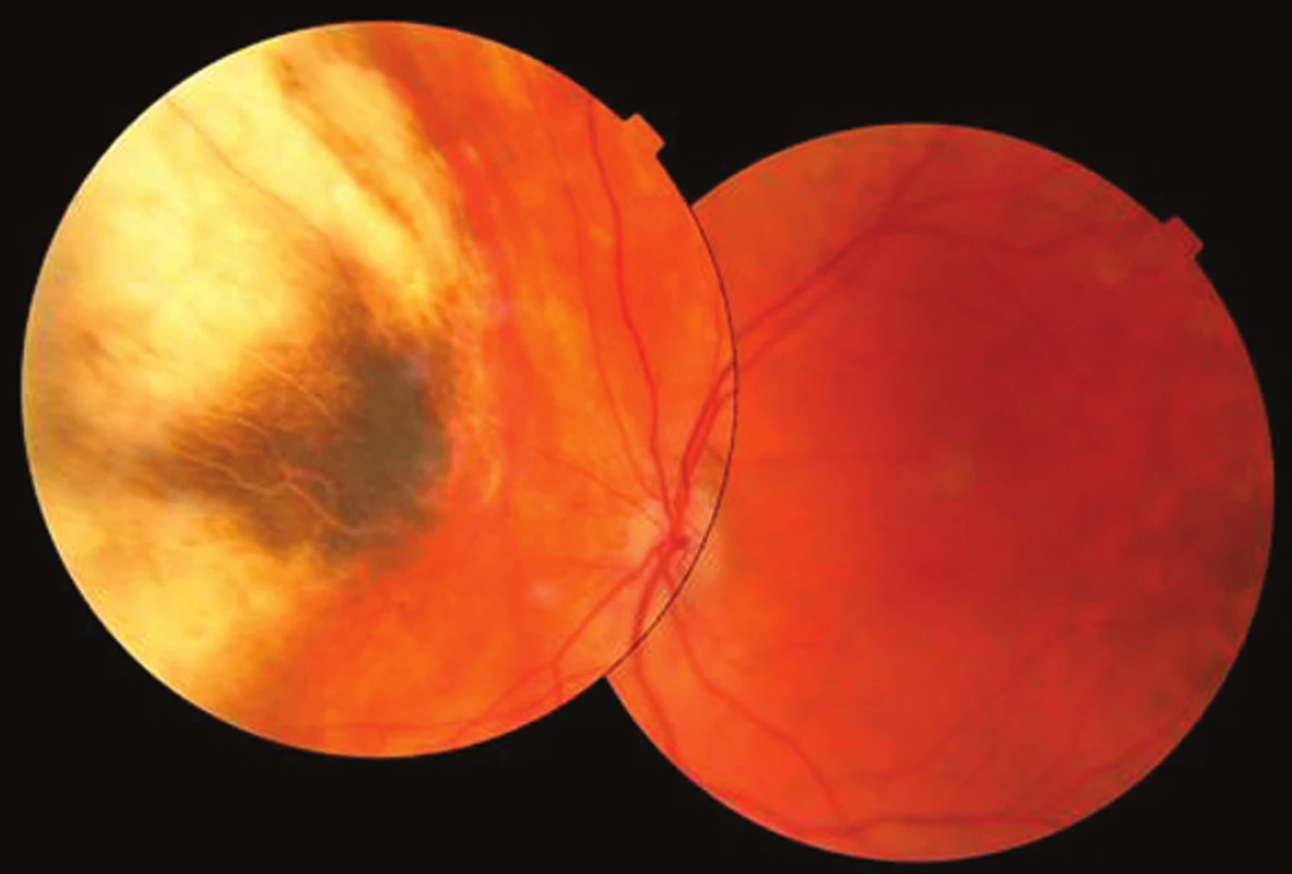 Pacient 2. Fotografia očného pozadia 9,6 rokov po brachyterapii s intaktnou makulou a atrofickým tumorom