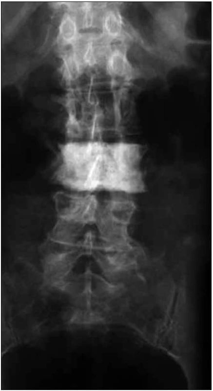 Předozadní RTG snímek páteře u pacientky s osteosklerotickým mnohočetným myelomem a POEMS syndromem.