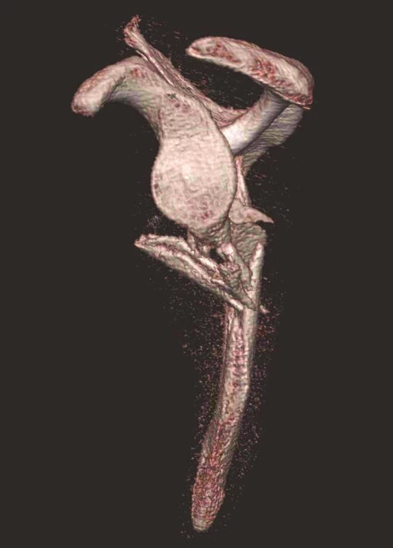 Třídimenzionální CT rekonstrukce – pohled z laterální strany Je vidět intaktní glenoid.
Fig. 4: Three-dimensional CT reconstruction – lateral view showing the intact glenoid