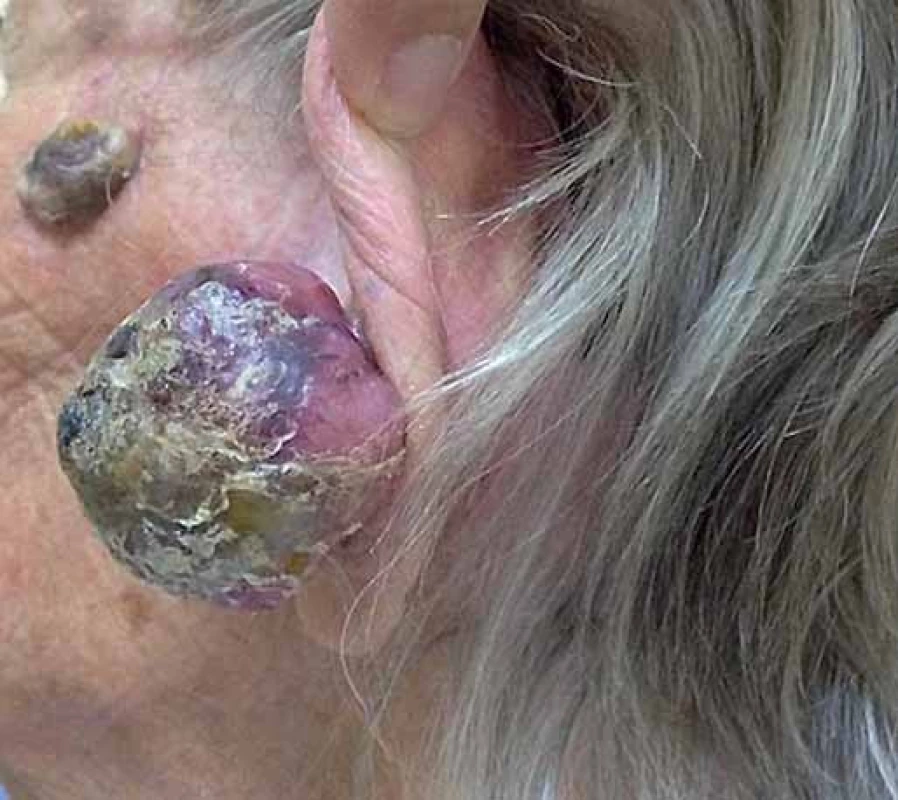 A solitary erythematous nodule with prominent vessels, hyperkeratotic and ulcerated surface on the left ear lobe (side view).