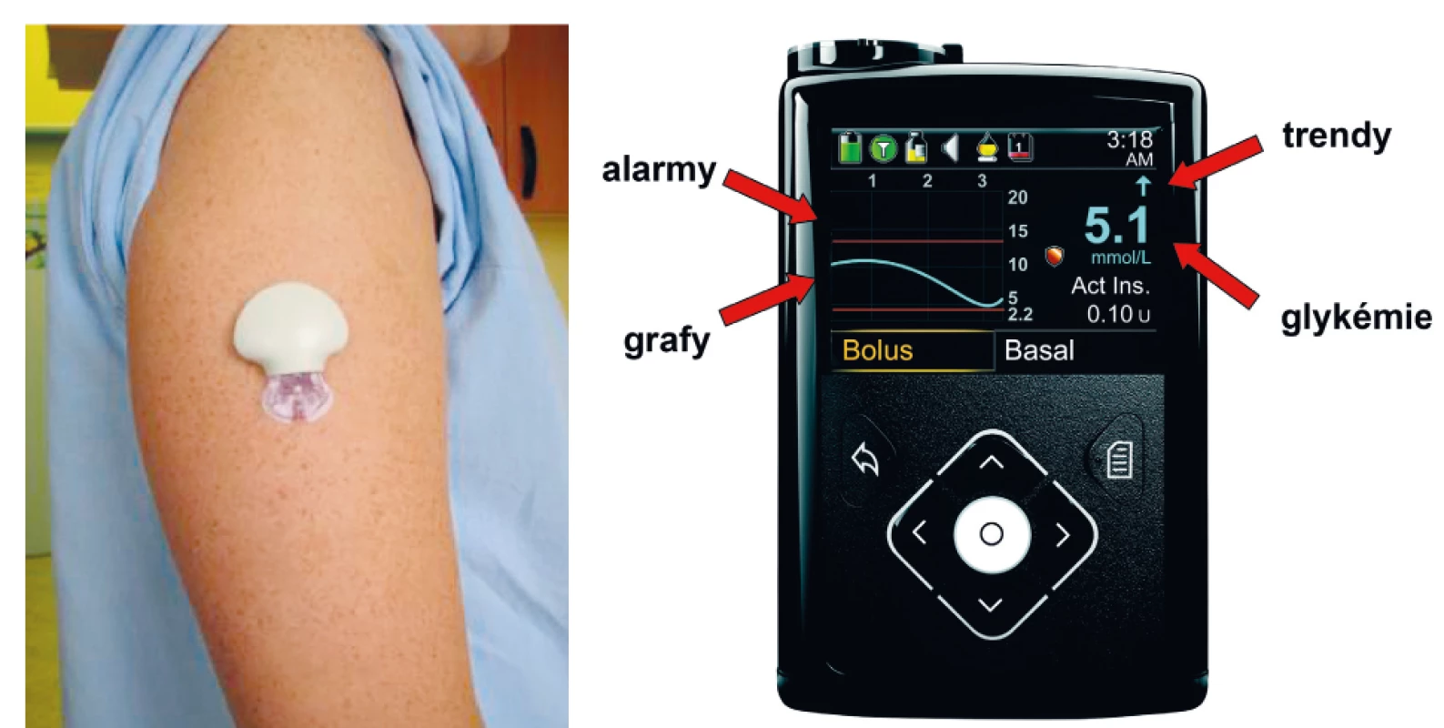 Senzor pro kontinuální monitorování glykémie zavedený subkutánně (A), přijímač (displej inzulinové pumpy) se základními
informacemi o aktuální dynamice glykémií (B).