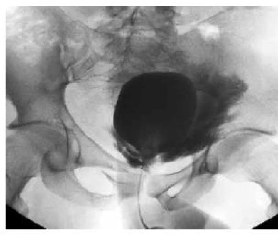 Cystografie – extraperitoneální ruptura močového měchýře
Fig. 8. Cystography – extraperitoneal rupture of the urinary bladder
