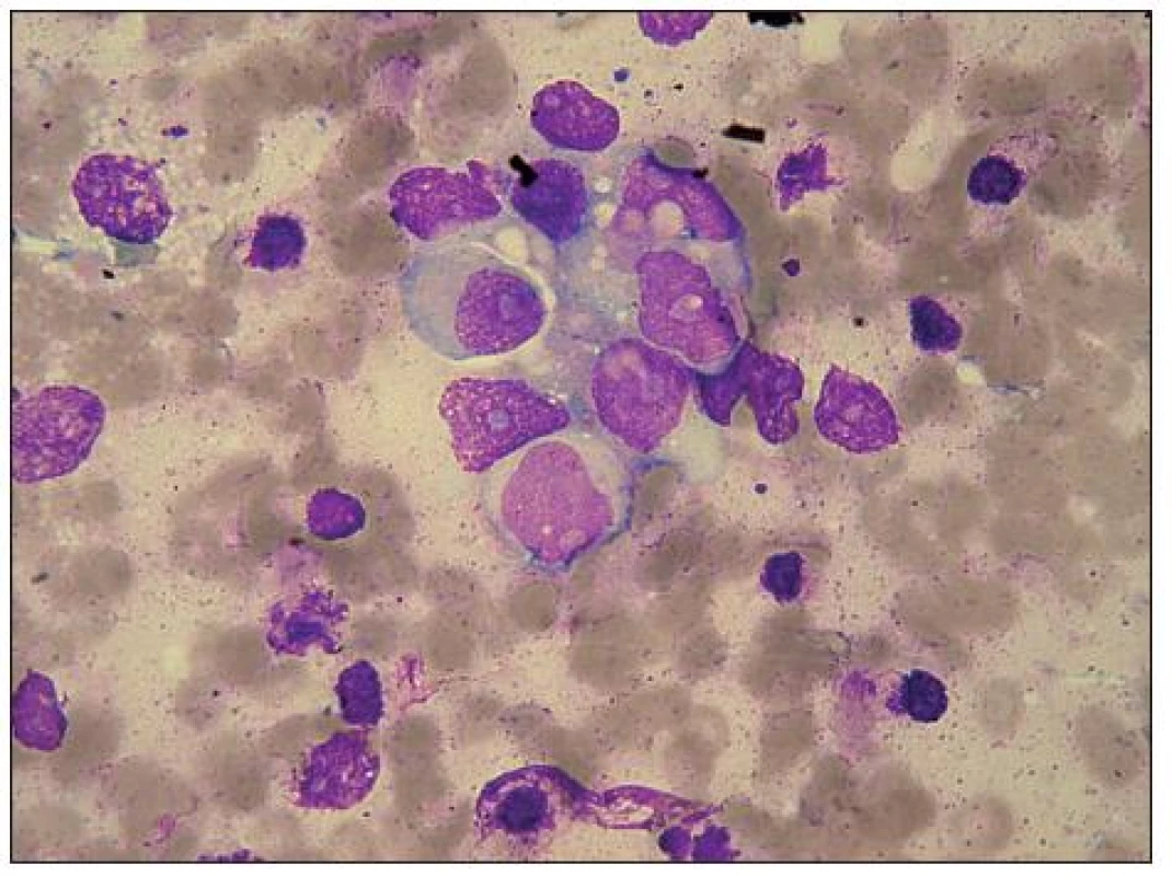 Neuroblastom – pro srovnání otisk primárního tumoru. Rozetovitý útvar neuroblastomových buněk s ganglioidní
diferenciací. Velká světlá, částečně excentricky uložená jádra, s velkými jadérky. Místy vakuoly v cytoplazmě. V pravé horní části rozetky ojedinělé fagocytované erytrocyty.