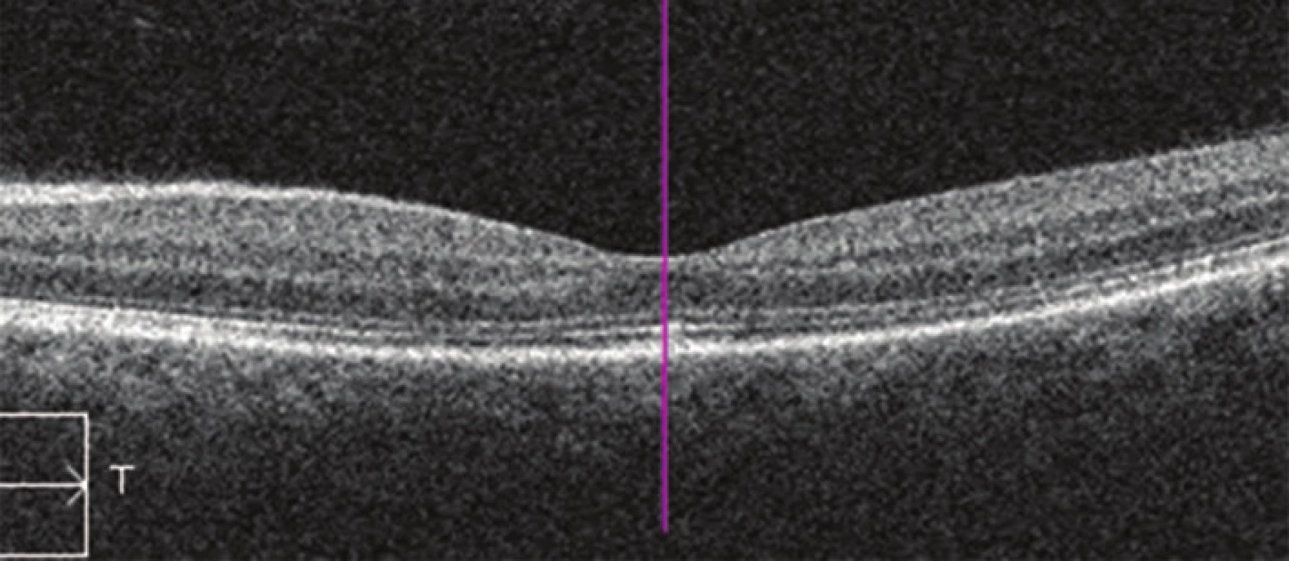 Nález na OCT na levém oku 2 měsíce po PDT (HD OCT Cirrus)