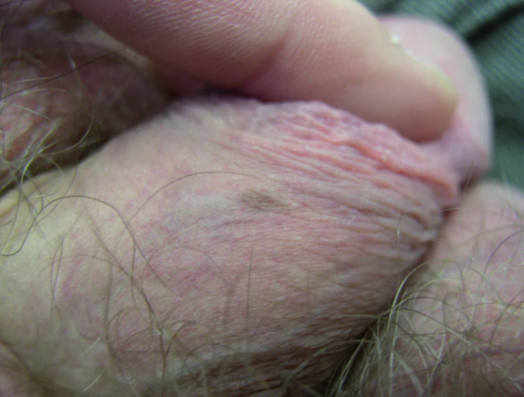 Genitálna melanotická makula – klinický obraz.