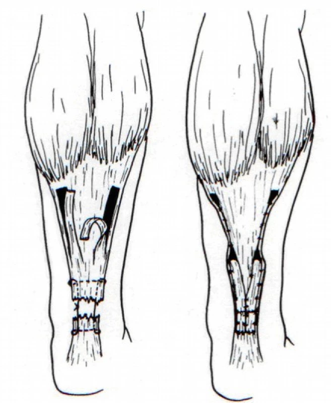 Plastika dle Lindholma [5] 
(Volně podle Lindholm, A.: A new method of operation in subcutaneous rupture of the Achilles tendon. Acta Chir Scand. 117, 261–270, 1959. )