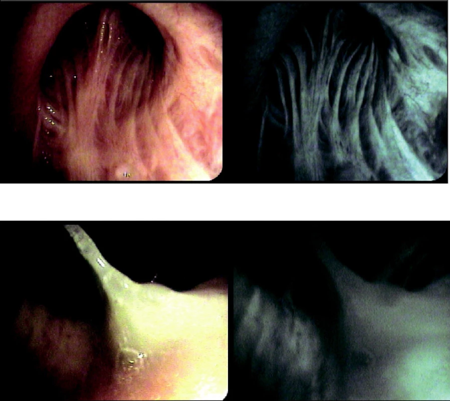 Sliznice zdravého pacienta (A) a pacienta (B) s CHOPN (povšechná retence vazkého hlenu) – obraz v bílém světle a pomocí autofluorescenčního modu bronchoskopu (archiv autorů)
