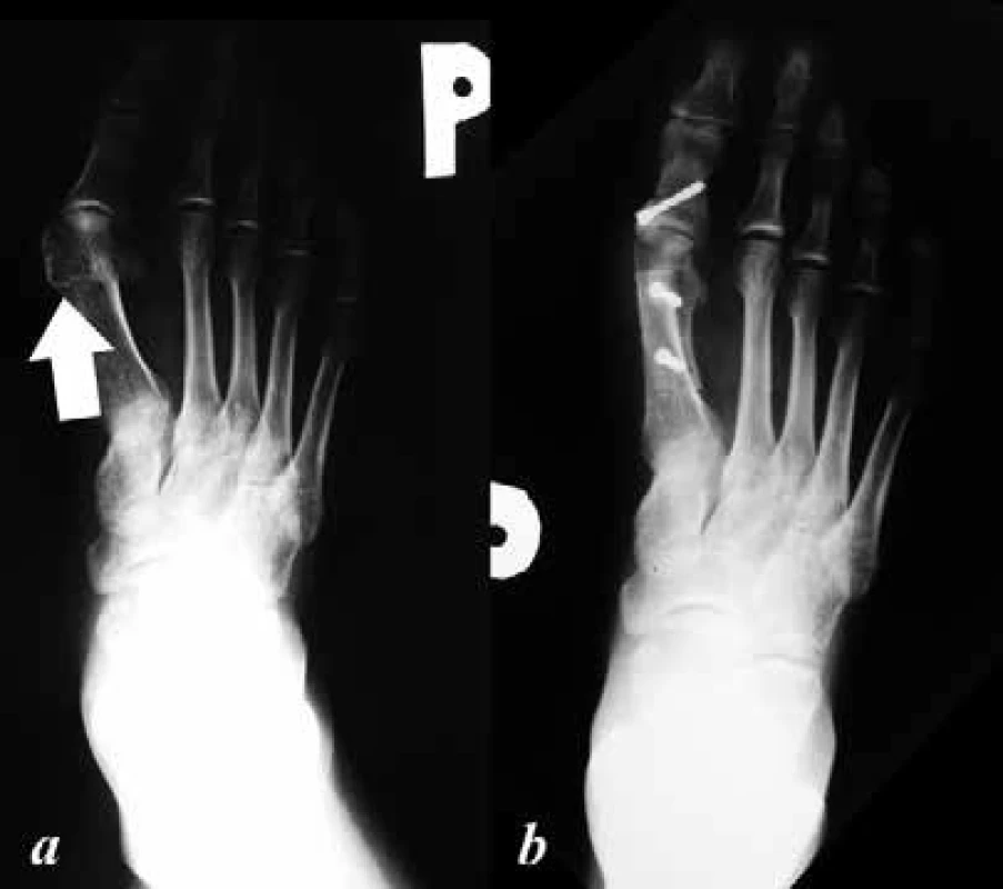 a: předoperační dorzoplantární RTG nohy, patrná varozita I. metatarzu s jeho prominující hlavičkou (šipka) a valgozitou palce – predilekční místo vzniku otlakových burzitid a ulcerací;
b: pooperační dorzoplantární RTG nohy, po provedených korekčních osteotomiích I. metatarzu a základního článku palce