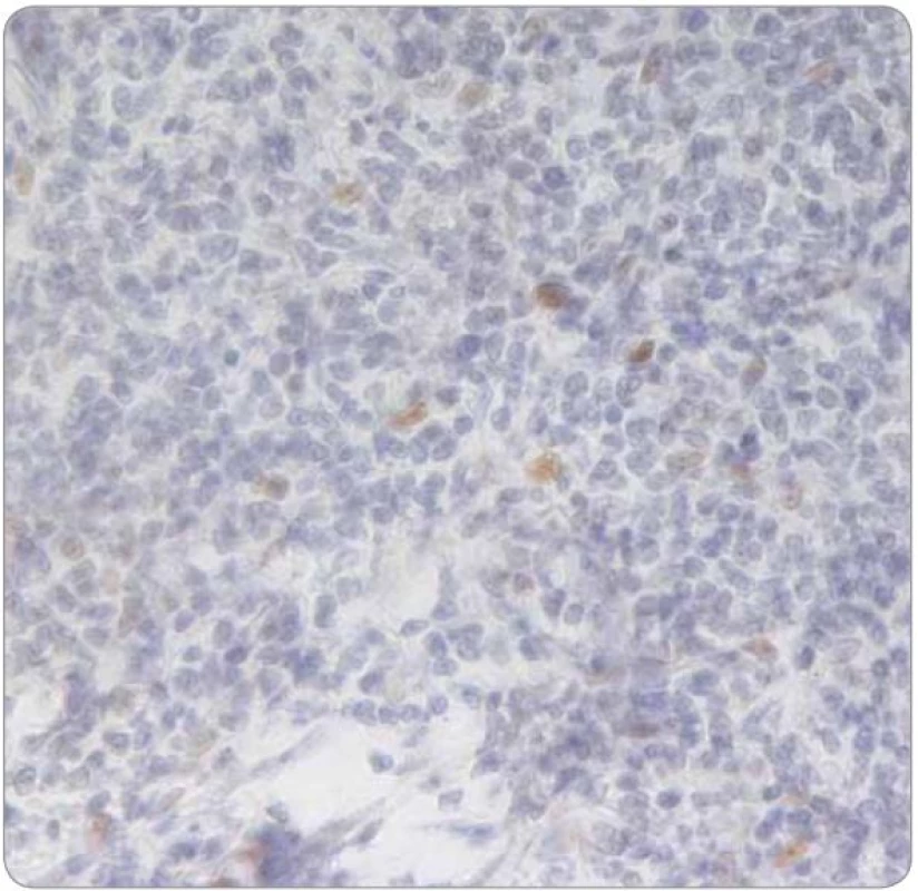 Slabě a heterogenně pozitivní barvení ER-α při imunohistochemickém vyšetření nádoru z první biopsie (2004; 400×).