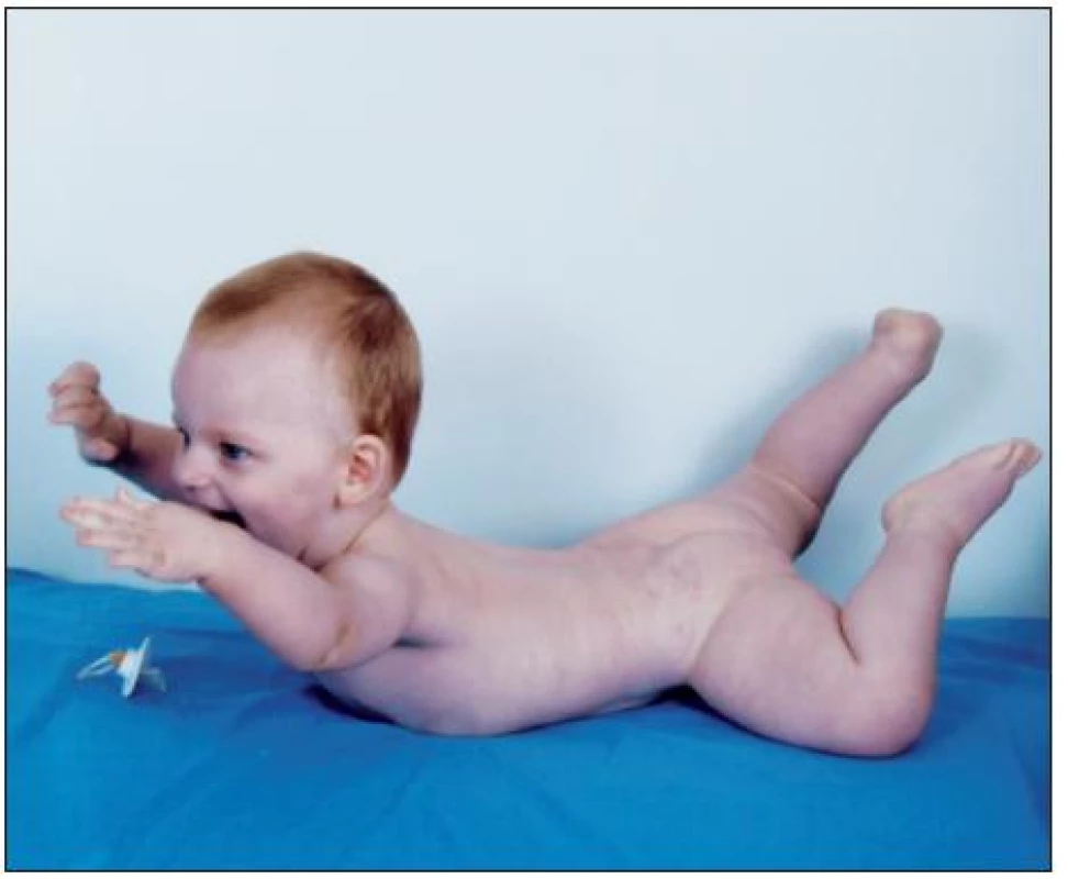 Typický fenotyp dítěte s Angelmanovým syndromem
(publikováno se svolením rodičů dítěte, fotoarchiv OLG Ostrava)
