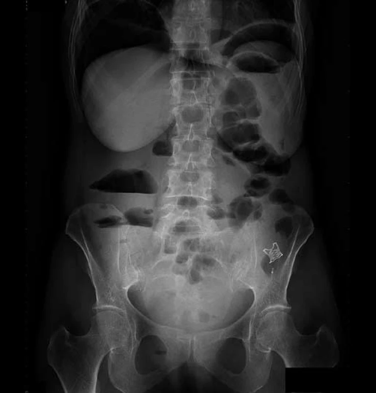 RT G nativ břicha 7. den po perforaci, přetrvávající pneumoperitoneum, OT SC&lt;sup&gt;®&lt;/sup&gt; klip v levé dolní polovině břicha.
Fig. 5. Abdominal X-ray, day 7 after perforation, persistent pneumoperitoneum, OTSC&lt;sup&gt;®&lt;/sup&gt; seen in the lower left abdomen.