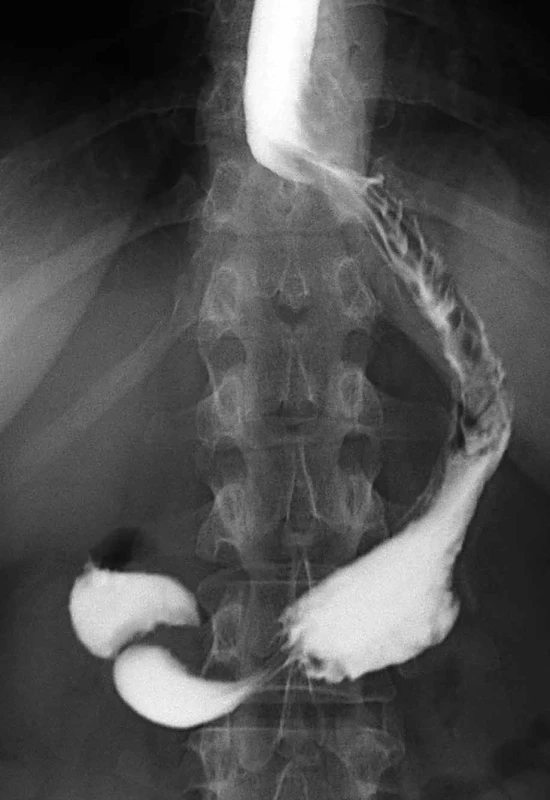 RTG obraz sleeve gastrectomy    Fig. 3: X-ray of sleeve gastrectomy