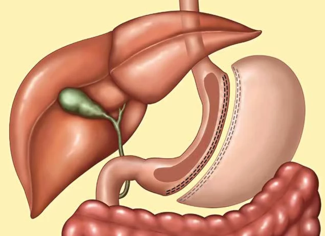 Tubulizace žalkudku    Fig. 2: Sleeve gastrectomy