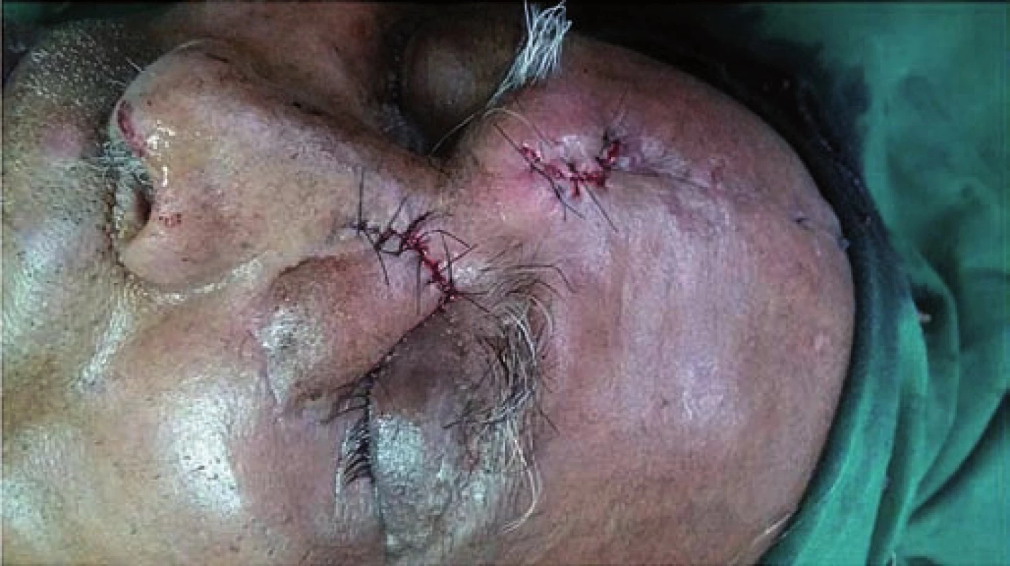 Clinical photograph taken after wide excision of lesion and reconstruction with median forehead flap.