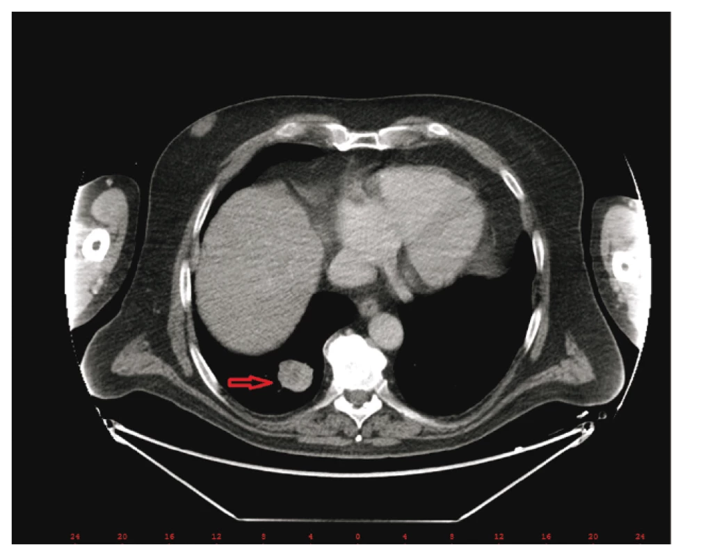Plicní metastáza před terapií ipilimumabem –
PET/CT (zdroj: Ústav nukleární medicíny VFN)