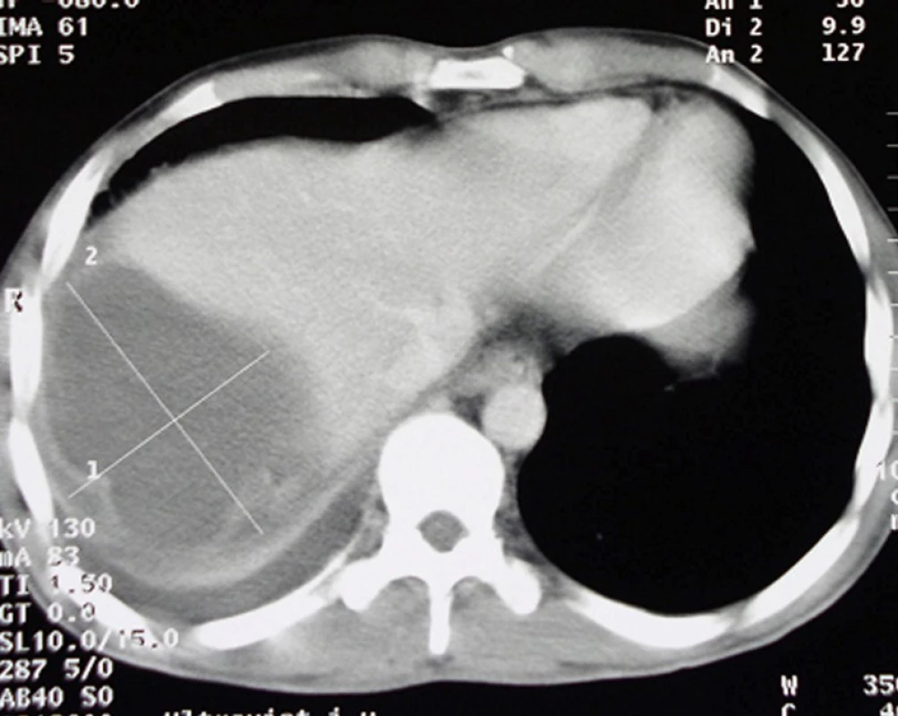 Traumatická ruptura VI. a VII. segmentu jater, pooperační CT